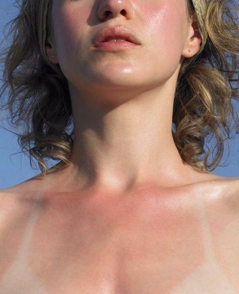 晒伤之后怎么修复最快的方法,晒伤后的修复方法