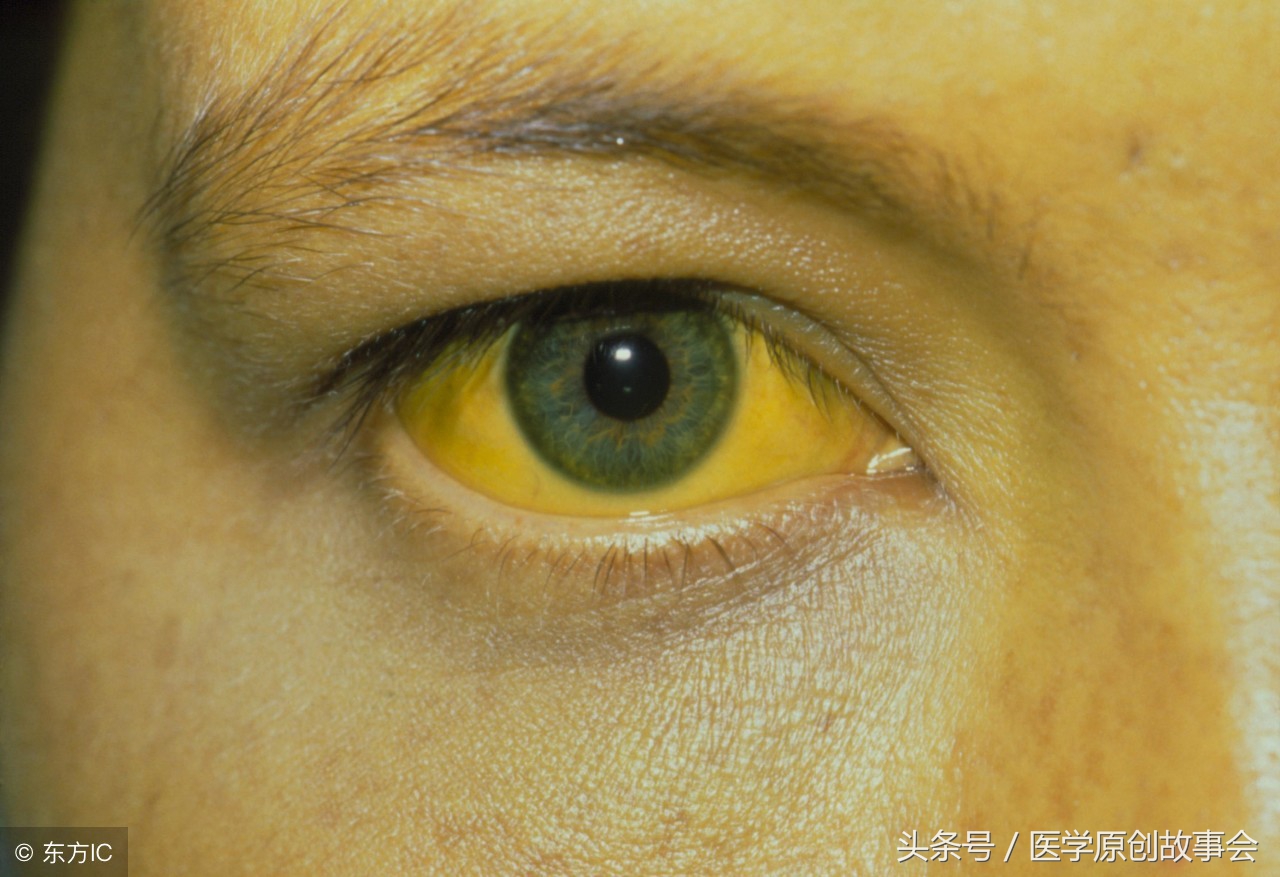 肝硬化晚期一定要做肝移植吗,肝硬化肝移植费用和后续治疗费用