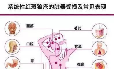 治红斑狼疮直播,红斑狼疮最新免疫抑制剂