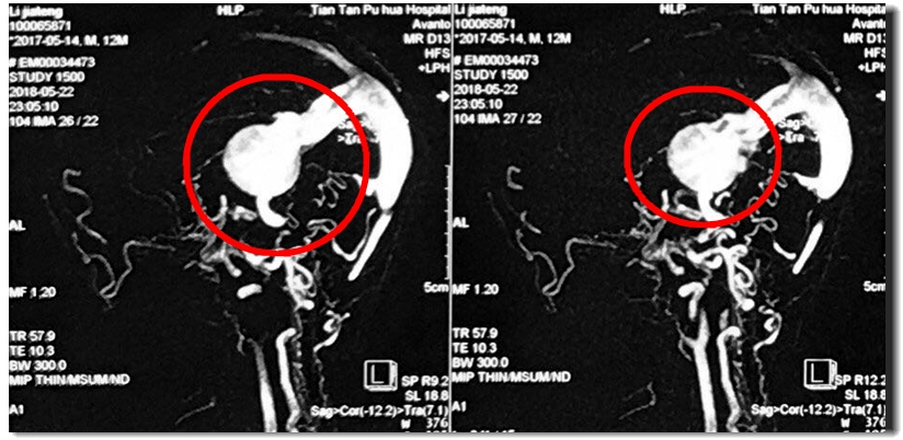 哭的时候额头爆青筋，手术发现脑子里有个“小苹果”在偷血