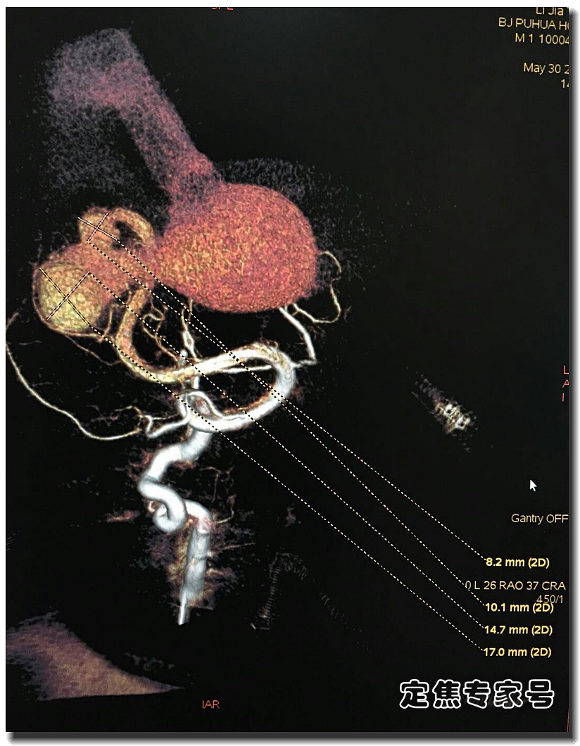 哭的时候额头爆青筋，手术发现脑子里有个“小苹果”在偷血
