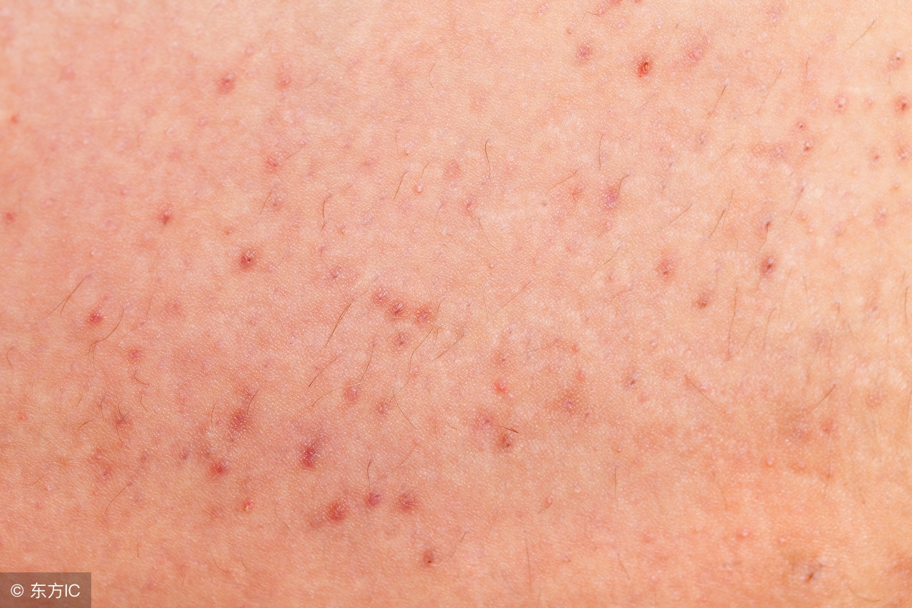 毛囊炎的症状是什么表现,毛囊炎发病时有哪些症状