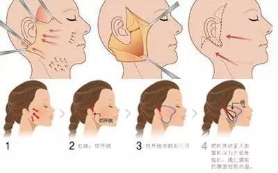 微创除皱手术与大拉皮除皱手术,微创除皱和拉皮的区别