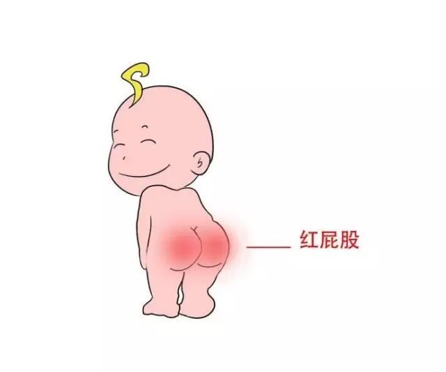 婴儿红屁股怎么回事,婴儿红屁股为啥
