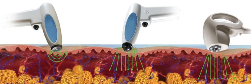 如何解决掉显老又讨厌的法令纹,法令纹不用愁一招帮你改善