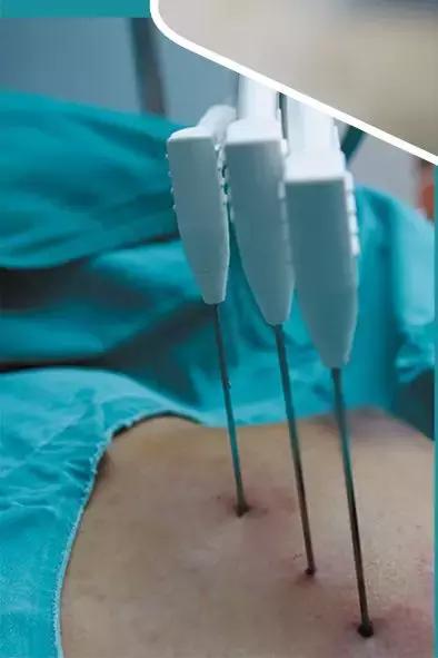 微创冷冻治疗癌症,氩氦刀冷冻消融技术治疗癌症