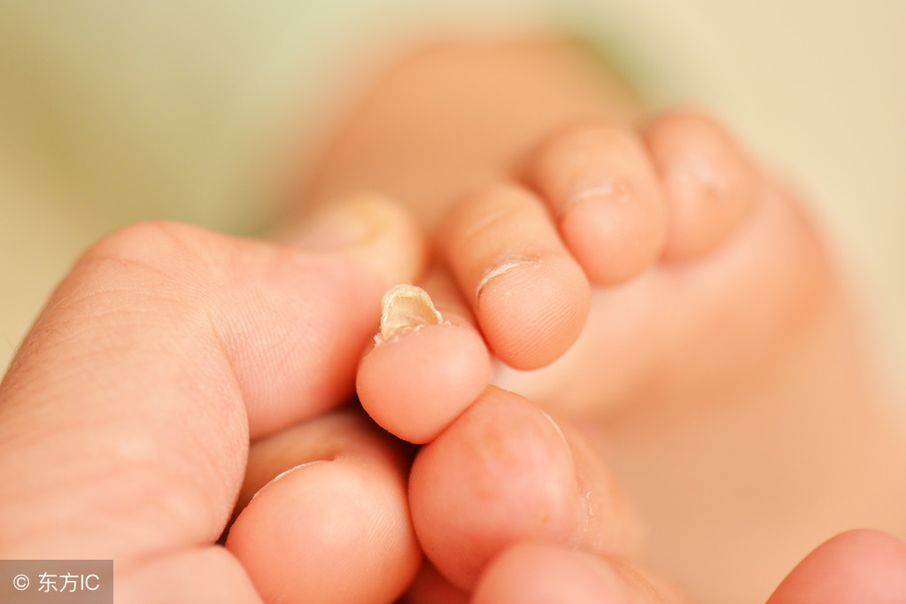 灰指甲是在霉菌交互情况下感染的，怎么治疗有效呢