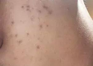 祛痘印干货分享,最全祛痘攻略快速祛痘不留痕