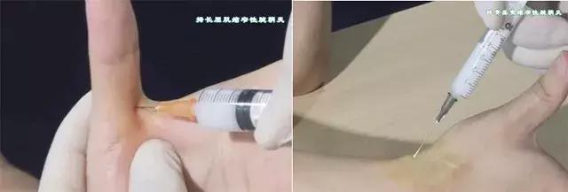 关于封闭疗法的知识,封闭治疗到底好不好