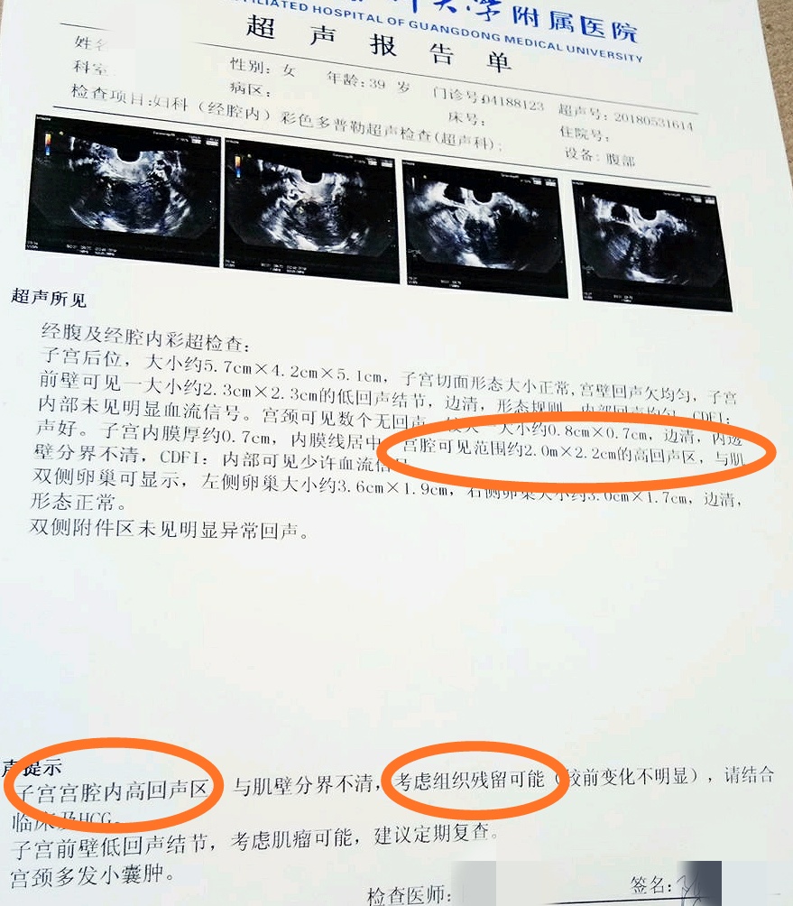 可以自己带的避孕环,不用放在宫腔的节育环