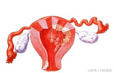 子宫内膜厚水样白带,子宫内膜厚内膜息肉白带水样