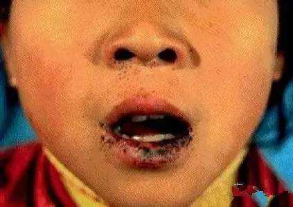 嘴唇上出现黑斑与肠胃疾病,下嘴唇上有黑斑就是胃有问题吗