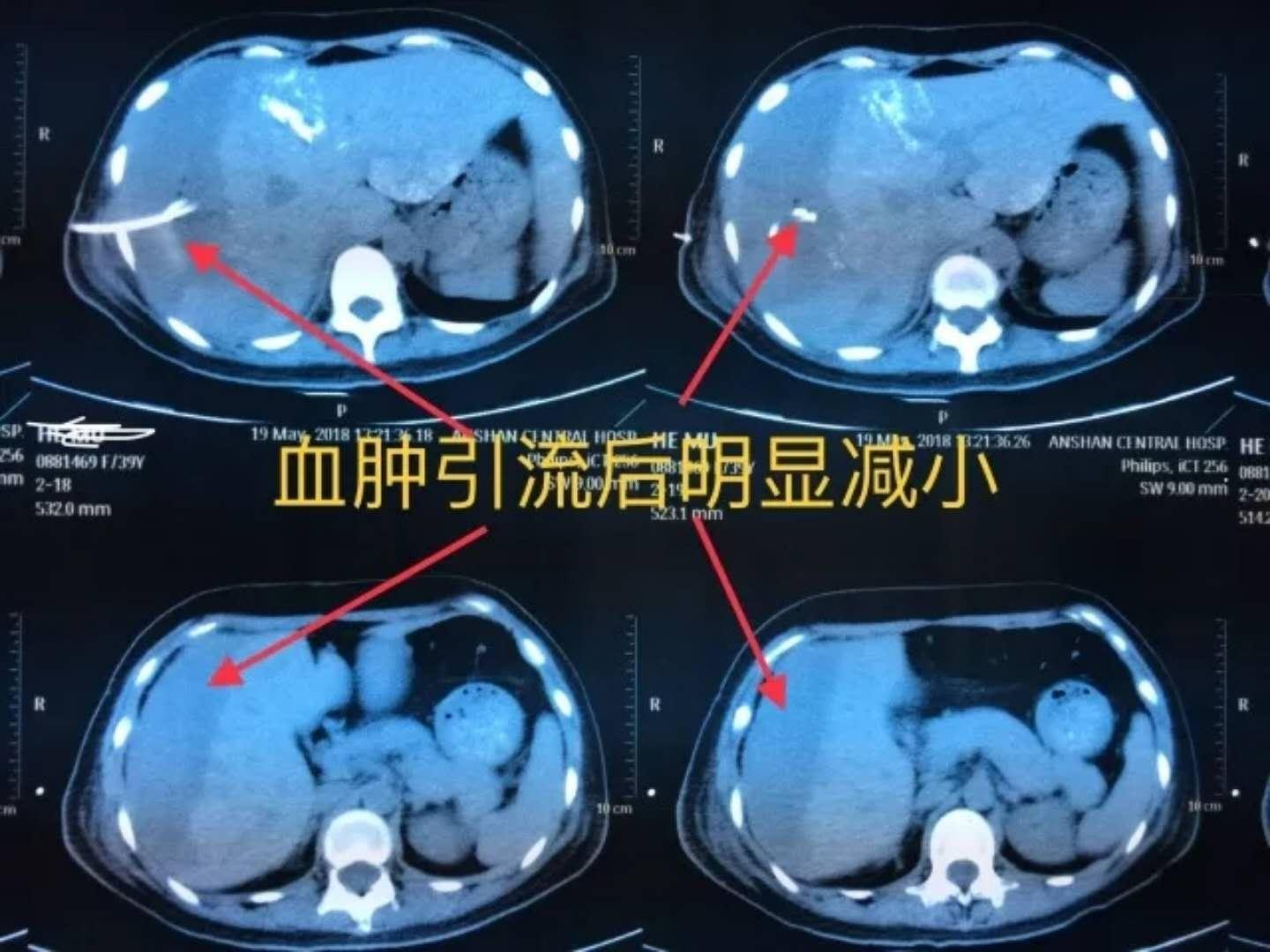 避孕药这3个副作用吃之前要知晓,避孕药吃了很多次会出现什么情况