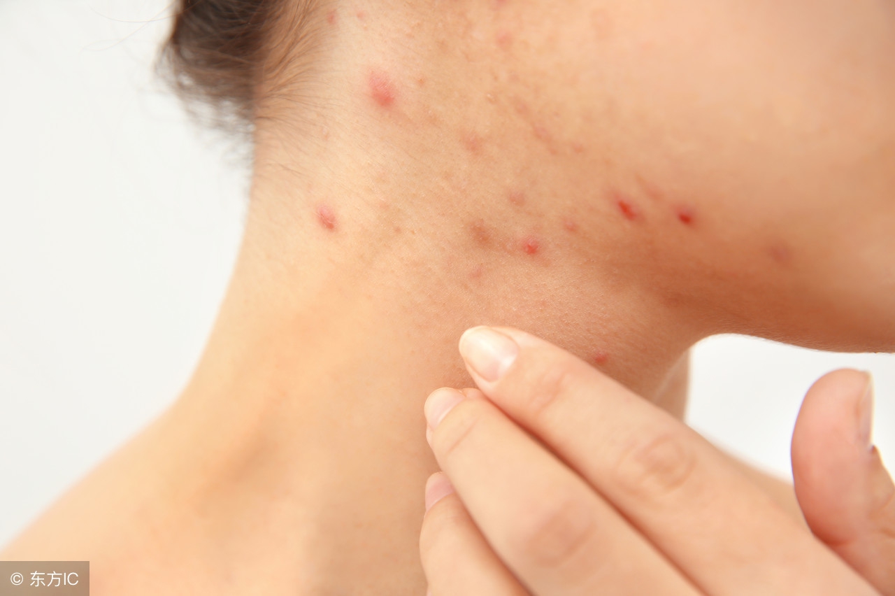 小孩睡醒身上起大片的疙瘩,睡醒后身上起疙瘩像虫子咬到一样