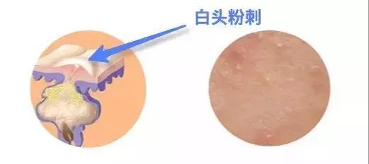 去除闭口有什么最简单的好办法,如何简单有效去闭口