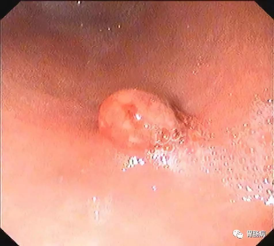 长了胃息肉怎么办,胃长息肉有什么治疗好的方法