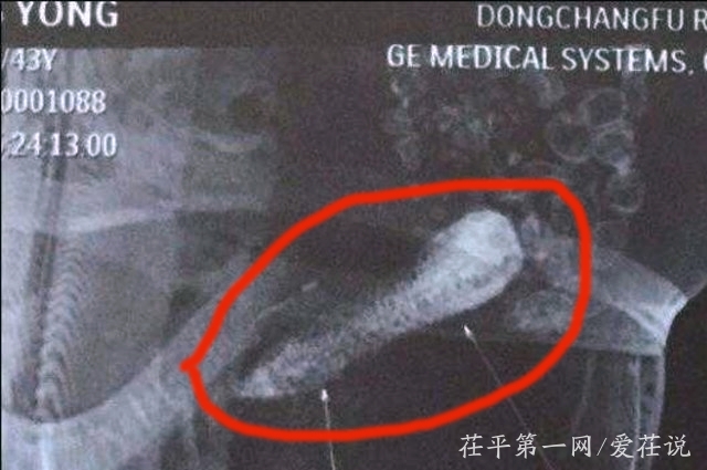 山东聊城一男子酒后摆弄瓜果，15厘米黄瓜滑入直肠，上演惊险一幕