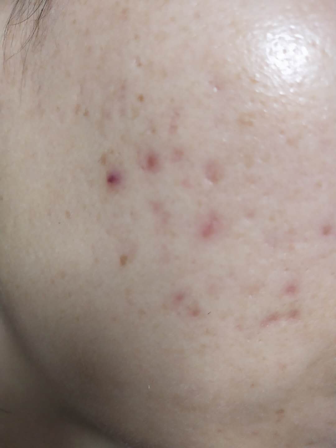 祛额头痘痘和痘印小妙招学生党,去痘痘痘印方法简便