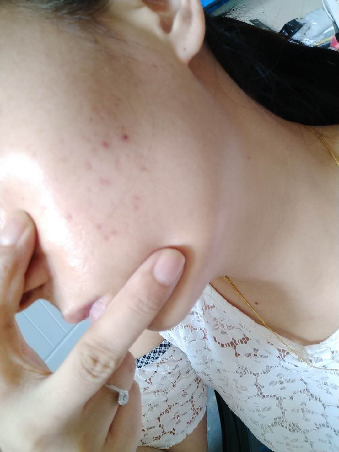 祛额头痘痘和痘印小妙招学生党,去痘痘痘印方法简便