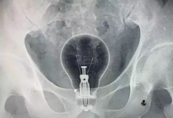 生吞灯泡取不出来怎么办,吞灯泡没取出来医院怎么处理