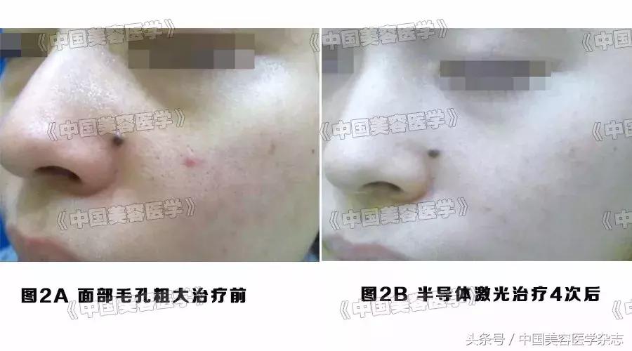 毛孔粗大修复小妙招不要护肤品,毛孔粗大怎么修复不花钱