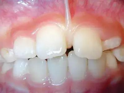 孩子口腔系带有什么危害,儿童上唇系带连接牙龈有什么影响