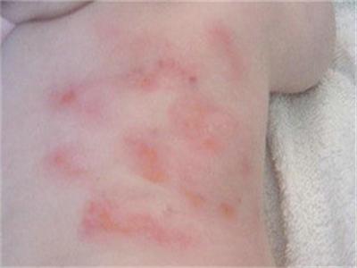 容易长湿疹教你3个方法赶走湿疹,宝宝湿疹快速消除小窍门