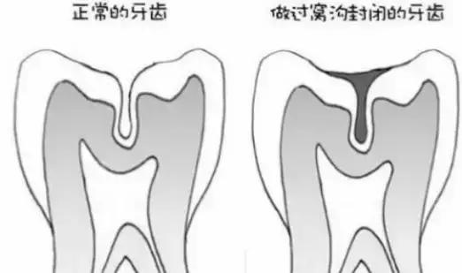 乳牙蛀了不用管,乳牙蛀了没掉下来