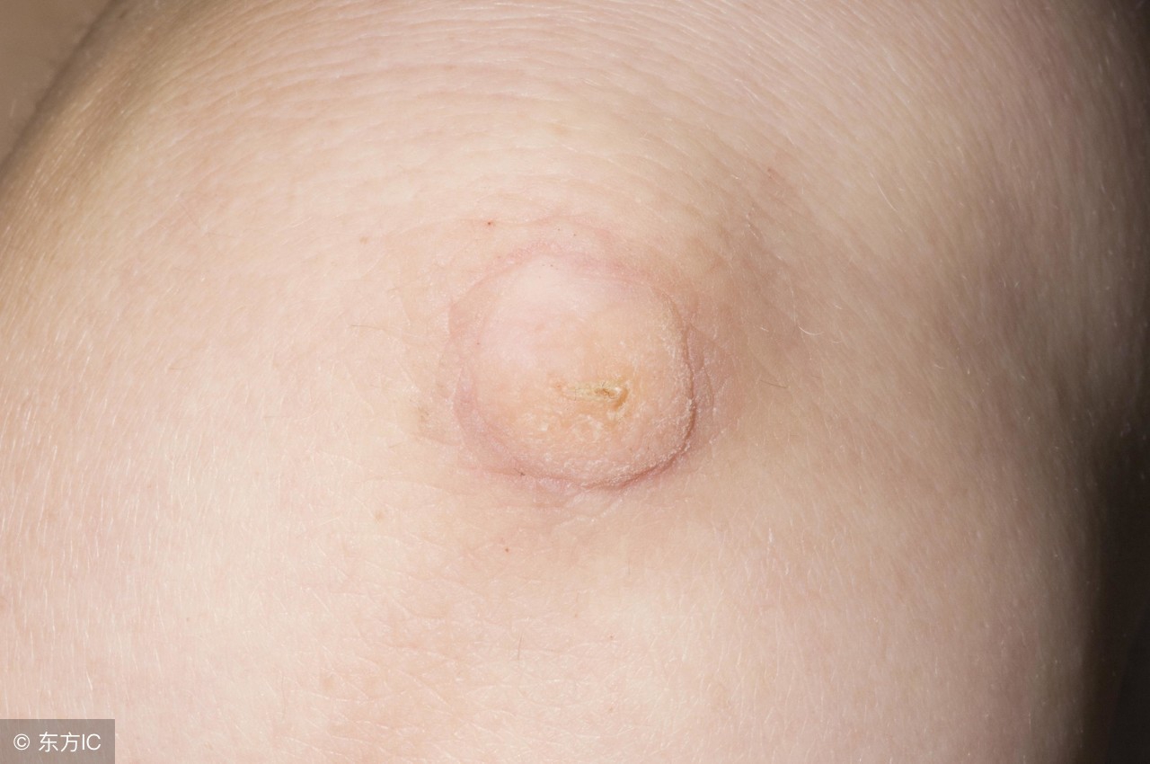 寻常疣怎么预防传染给家人,预防寻常疣可以接种疫苗吗