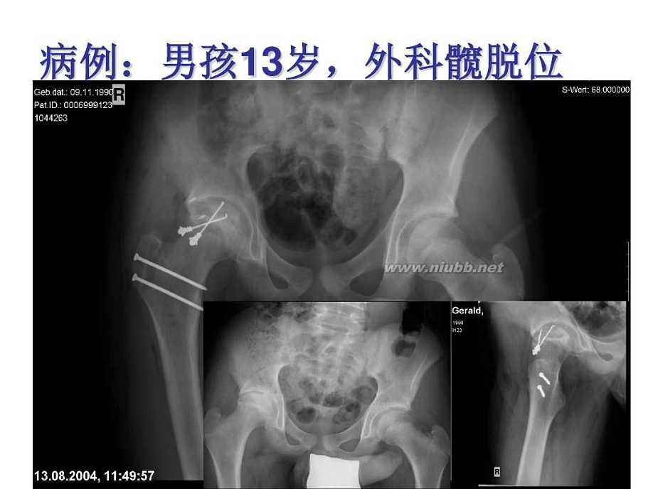 小孩臀纹不对称跛行,宝宝腿纹对称臀纹不对称做什么操