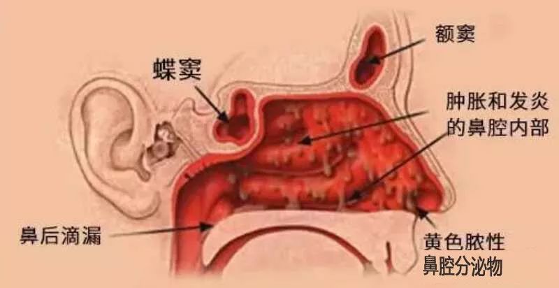 鼻炎是会呼吸的痛！赶走鼻炎，让孩子畅快呼吸