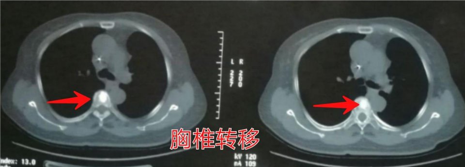 癌症靶向药治疗一年费用是多少,免疫加靶向治疗癌症几次能见效