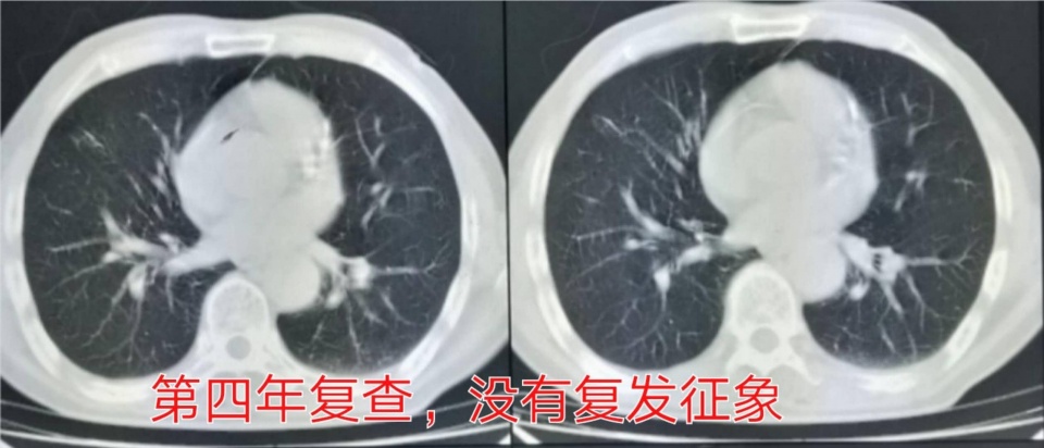 癌症靶向药治疗一年费用是多少,免疫加靶向治疗癌症几次能见效