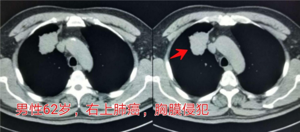 癌症靶向药治疗一年费用是多少,免疫加靶向治疗癌症几次能见效