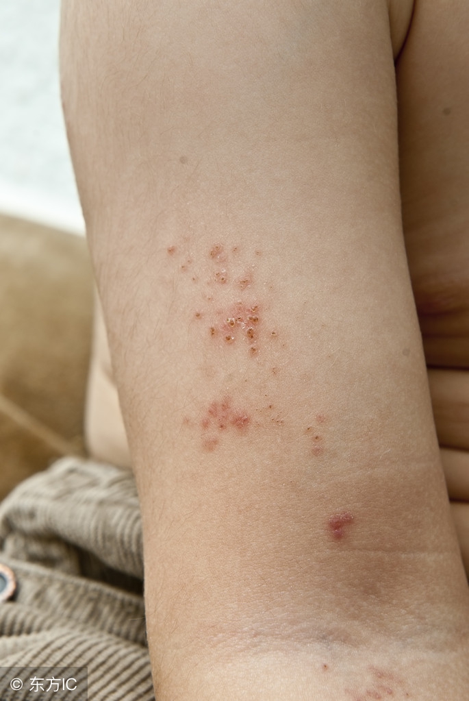 这个季节常见儿童皮肤病,芬母治疗婴儿湿疹冒水效果怎样