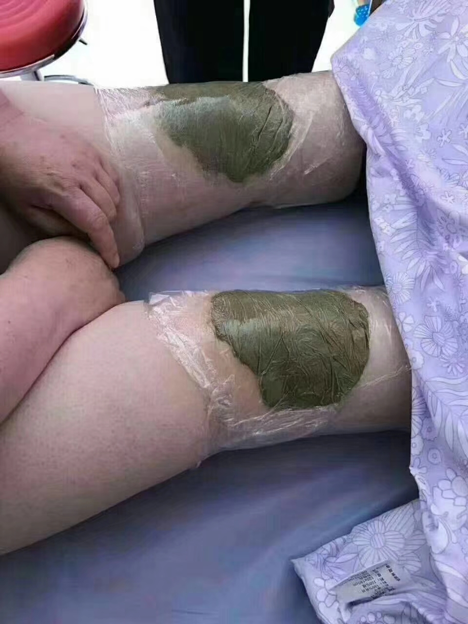 简述半月板损伤的病因及治疗,半月板损伤症状健康科普