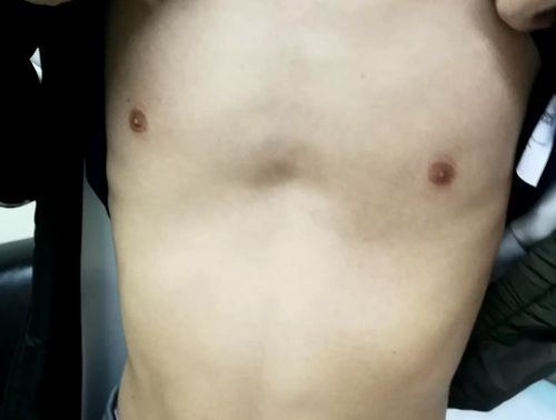 年龄大的重症漏斗胸可以动手术吗,成年人漏斗胸没有症状需要治疗吗