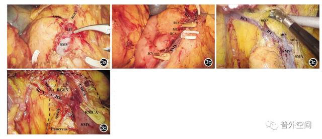 腹腔镜右半结肠癌手术步骤,腹腔镜右半结肠癌