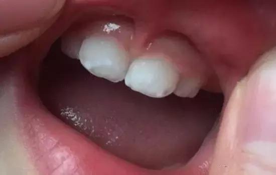 如何让你的蛀牙停止恶化三种方法,一招解决蛀牙的方法