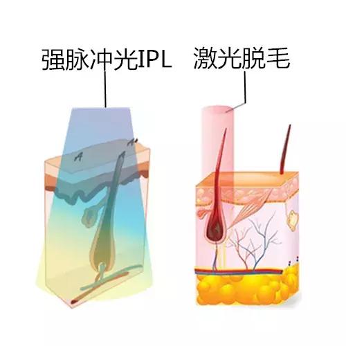 30分钟脱毛神器,最有效最实惠的脱毛神器