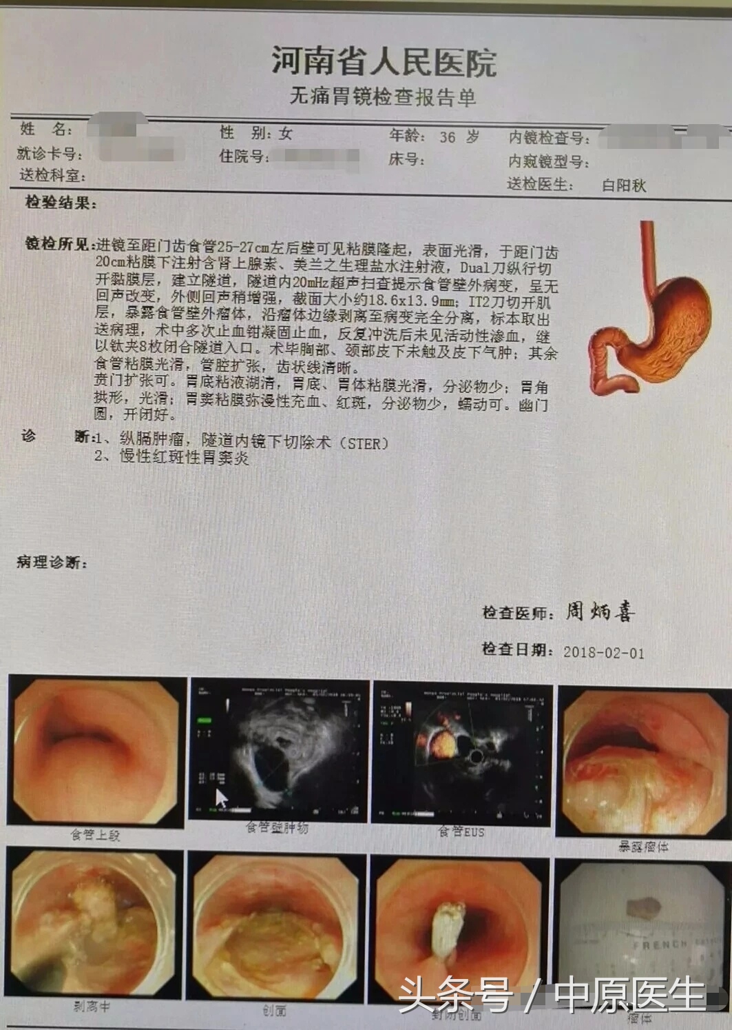 “挖窟窿”新进展：内科医生也耍手术刀，在食管开口切肿瘤