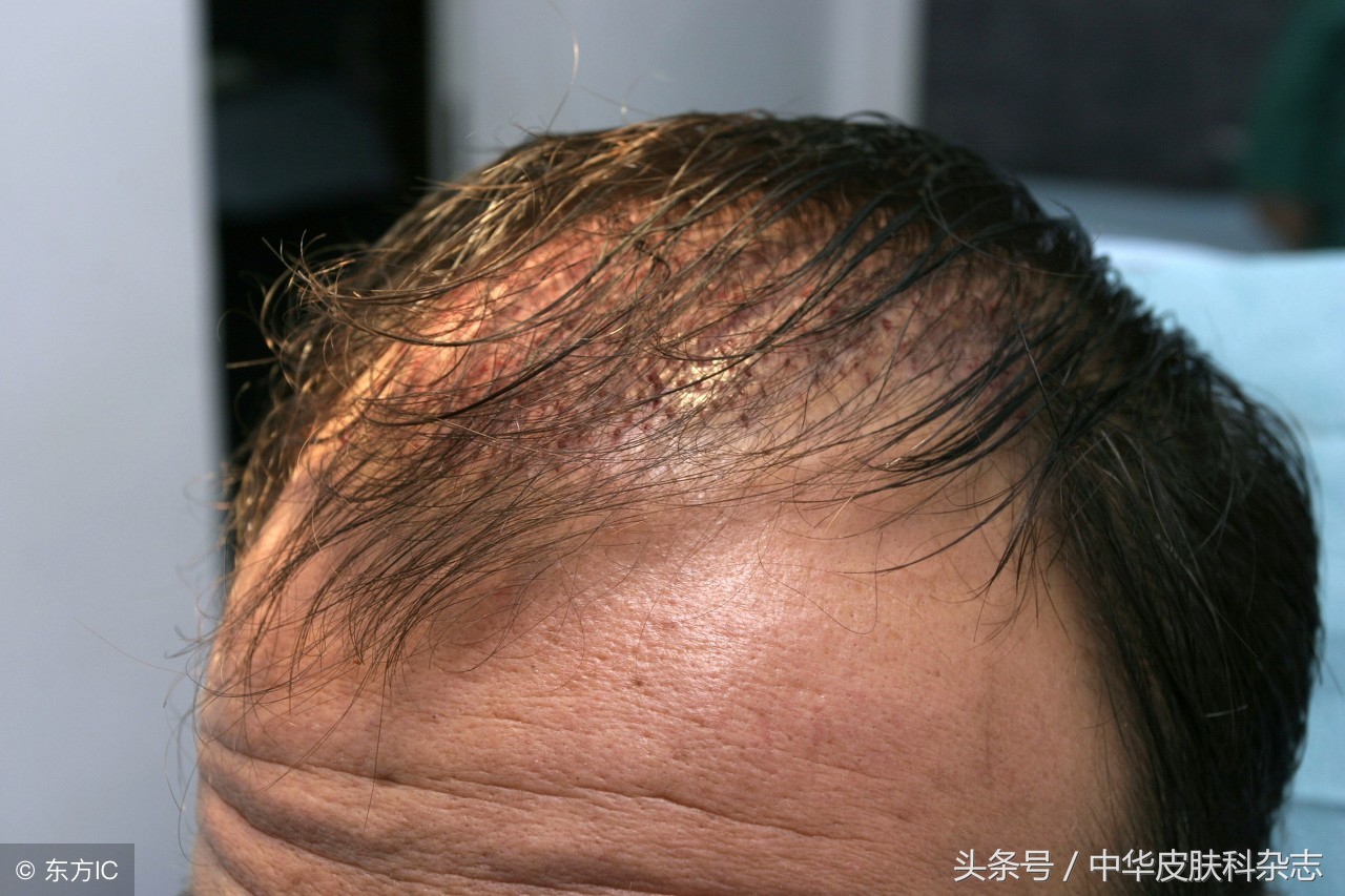 毛发毛囊移植有前景吗,毛发种植的效果好吗费用多少