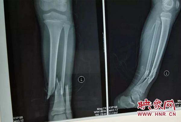 信阳淮河骨科医院是公立还是私立,信阳淮河骨科医院