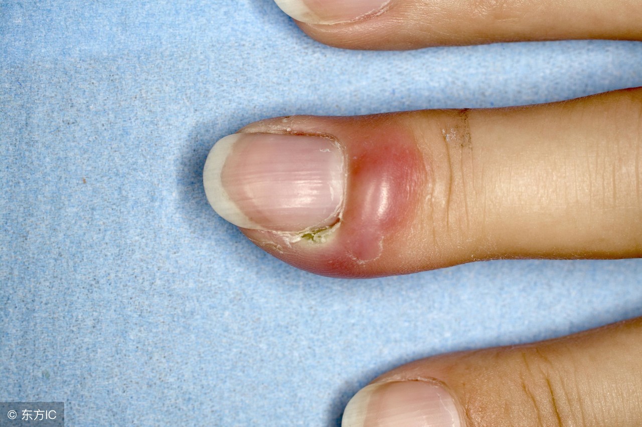 甲沟炎的症状究竟有哪些呢