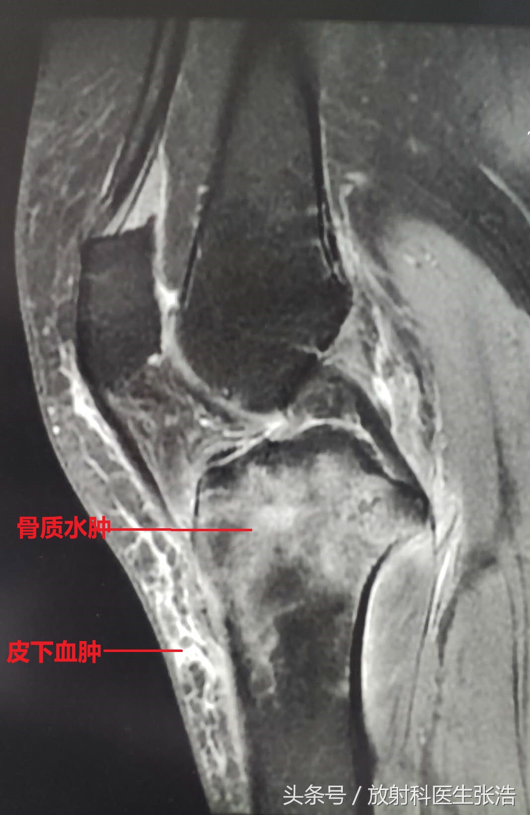 膝关节疼照x光片有用吗,膝关节疼痛x光片能看出来吗