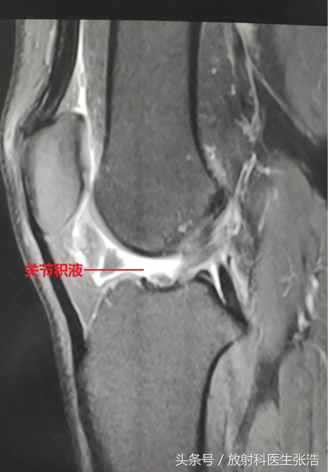 膝关节疼照x光片有用吗,膝关节疼痛x光片能看出来吗