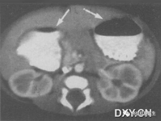 10种经典肠道影像征象：绳征、串珠征、螺纹征……你听过几个？
