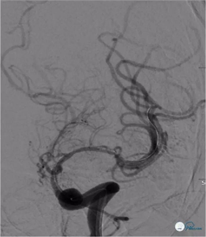 大脑中动脉支架术后再狭窄的几率,天坛医院介入脑血管手术