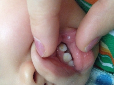 宝宝补牙全过程实操,宝宝束缚式补牙过程