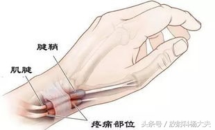 别只关注男足世界杯，看看这个好发于手部的病，女性多于男性